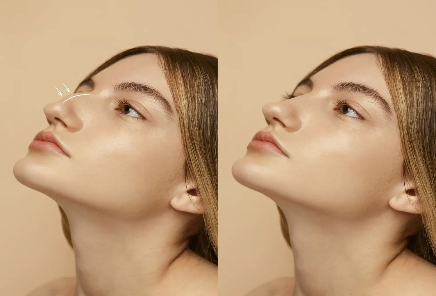 Nose Hump Removal
