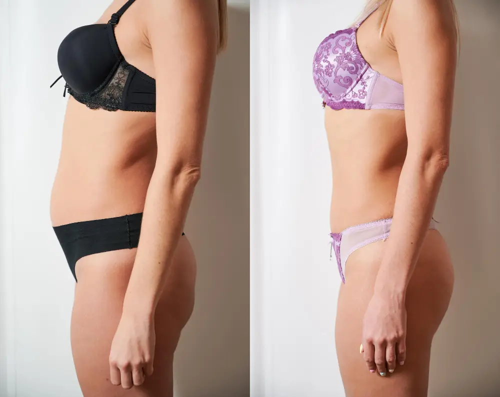 Tummy Tuck before and after