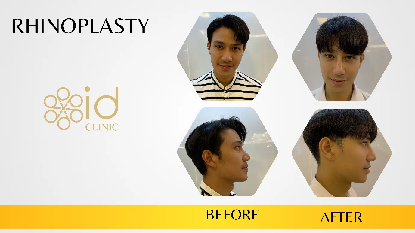 ผ่าตัดเสริมจมูก Rhinoplasty Id clinic -1