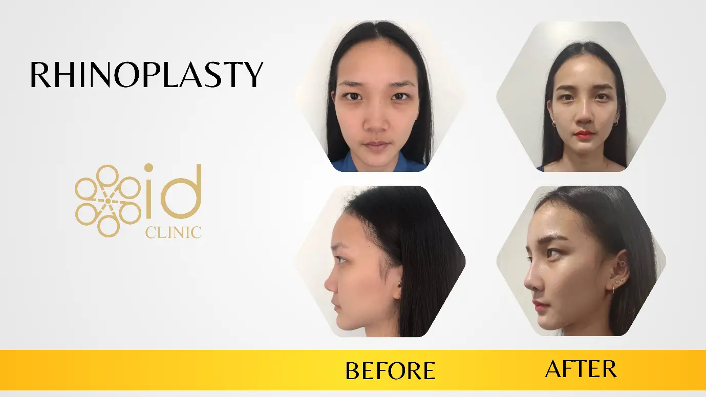 ผ่าตัดเสริมจมูก Rhinoplasty Id clinic -2