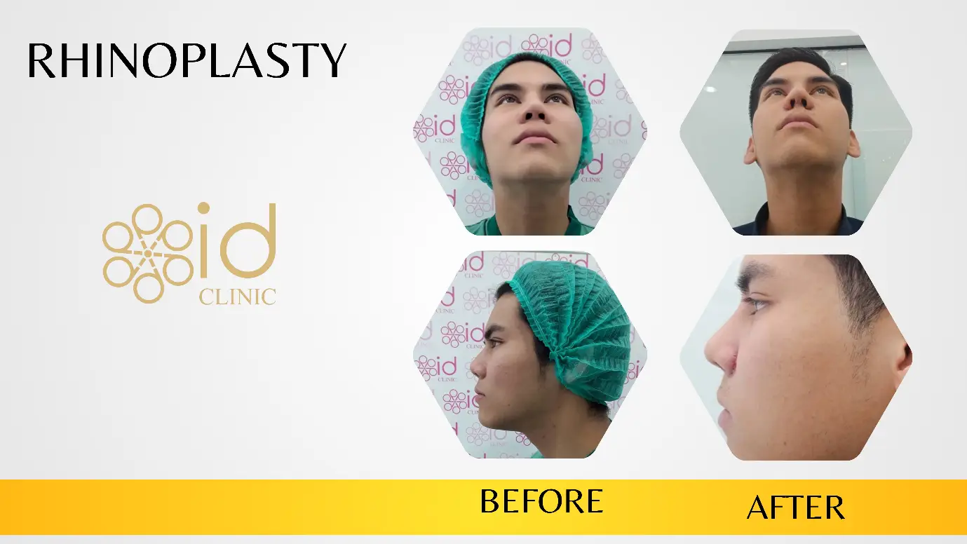 ผ่าตัดเสริมจมูก Rhinoplasty Id clinic -3