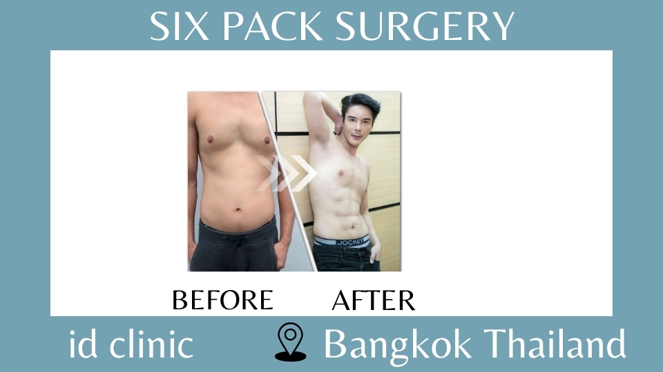 Vaser Hi-def Six pack Liposuction