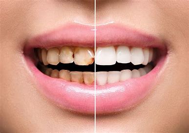 Compare Dental Veneers Before and After