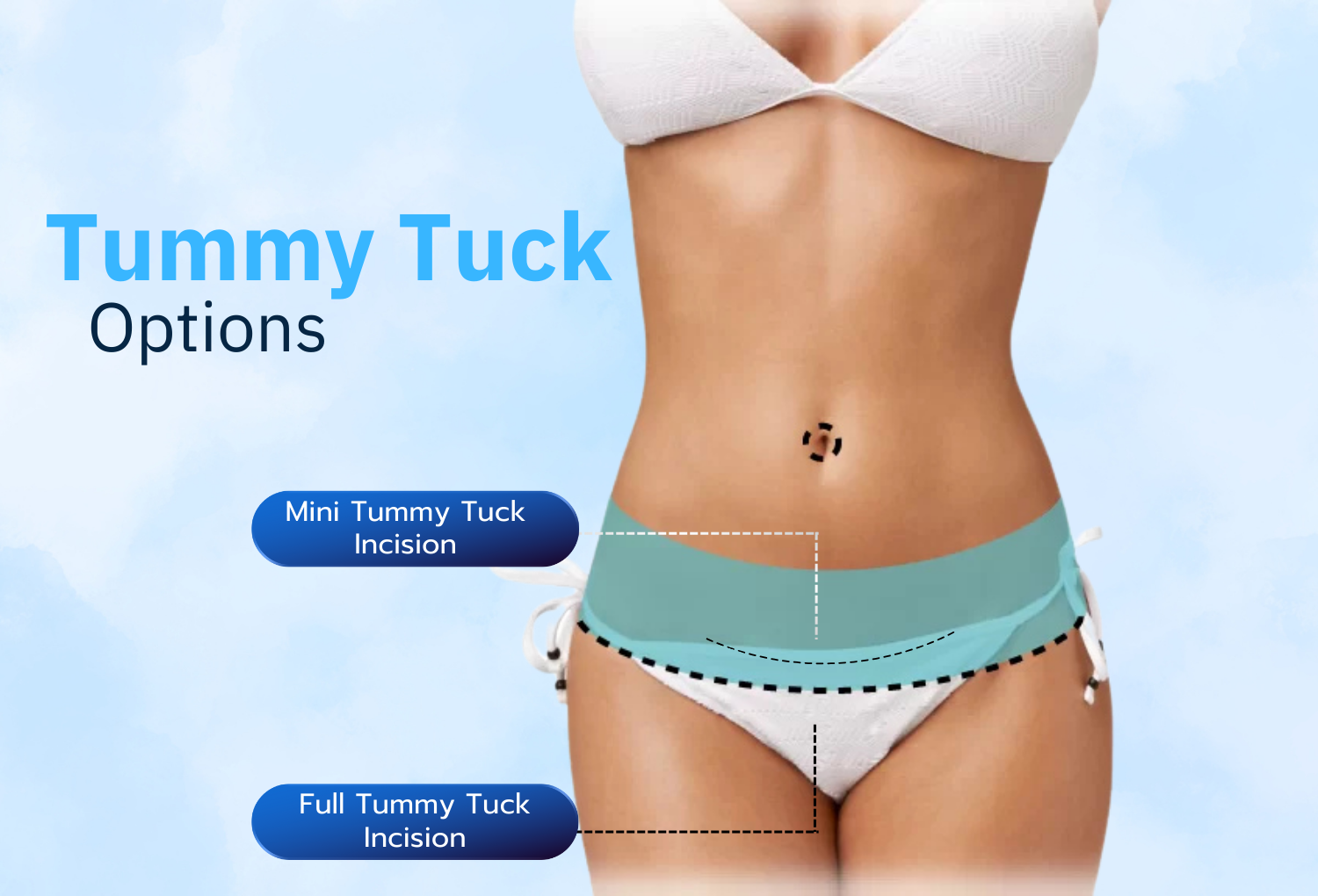 What is a Tummy Tuck? Who is it Suitable for? | Top Med World