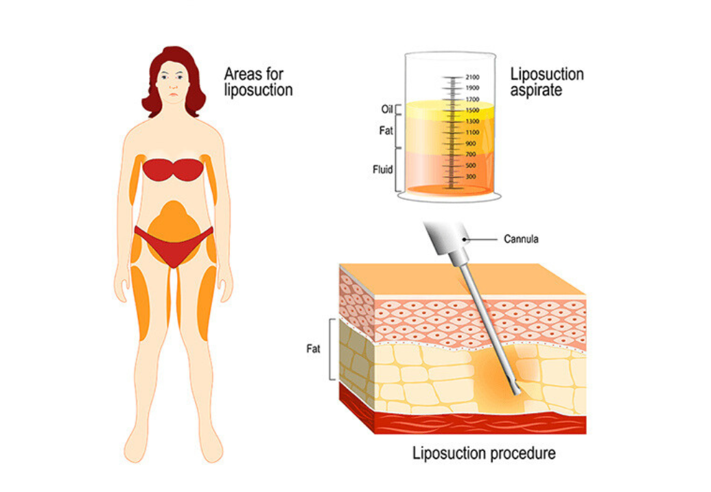 การผ่าตัดดูดไขมัน Liposuction