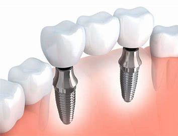 Dental Implants