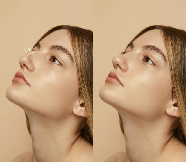 What is Nose Hump Removal?