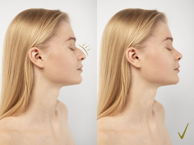 Nose hump